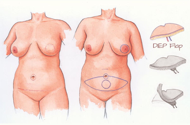 DIEP flap breast reconstruction