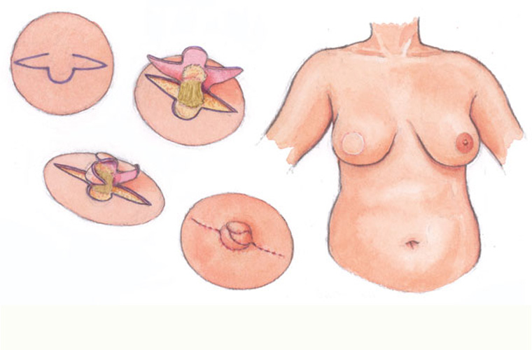 Nipple Reconstruction Breast Reconstruction Awareness